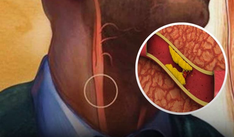 10 Signs You’re Living With Clogged Arteries