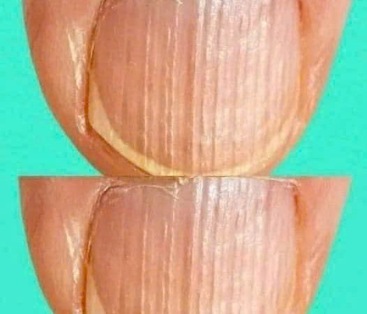 Rippled fingernails reveal secrets of possible disease