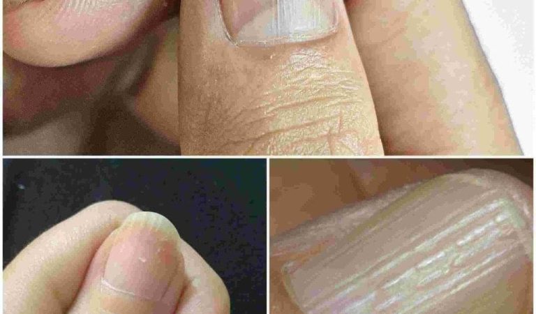 Understanding the Real Causes of Vertical Ridges on Your Nails