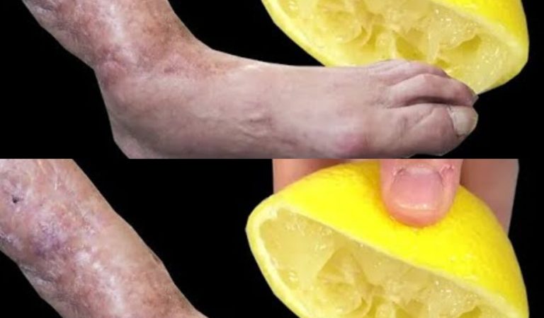 Mom’s Natural Remedy with Lemon: A Cure-All for Leg Pain, Rheumatism, Varicose Veins, Arthritis, Headaches, and Joint Pain