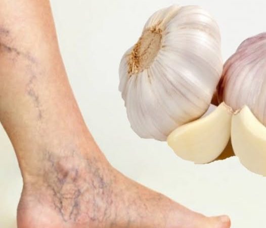 Natural Relief for Varicose Veins: Two Effective Garlic Remedies