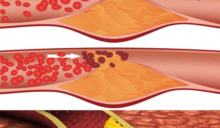Most people miss this. 10 warning signs saying your arteries are clogged Most people miss this. 10 warning signs saying your arteries are clogged
