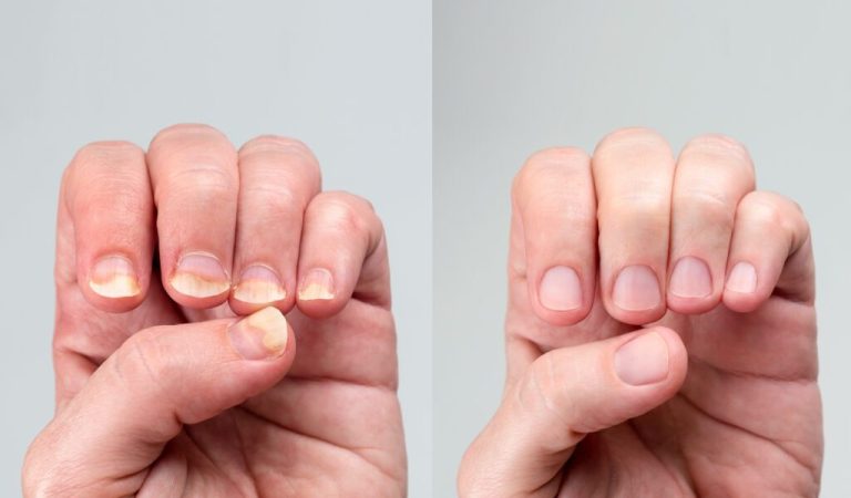 Proven folk remedies for treating nail fungus
