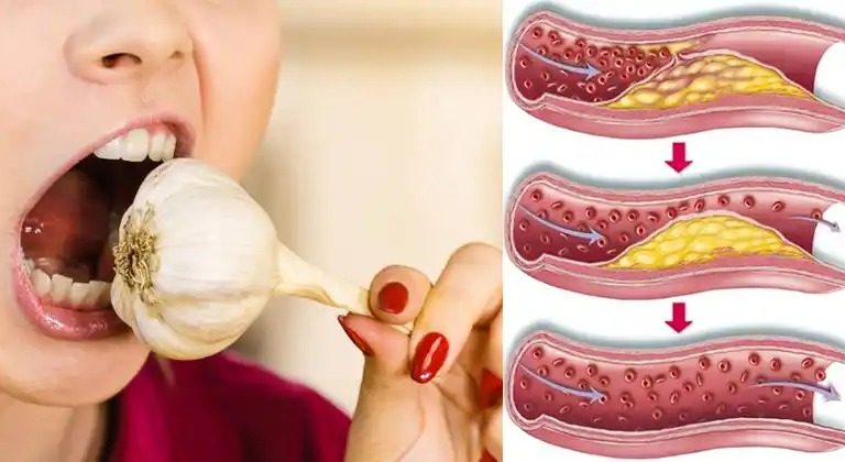 Eating Raw Garlic Daily: A Natural Way to Support Heart Health and Lower Cholesterol